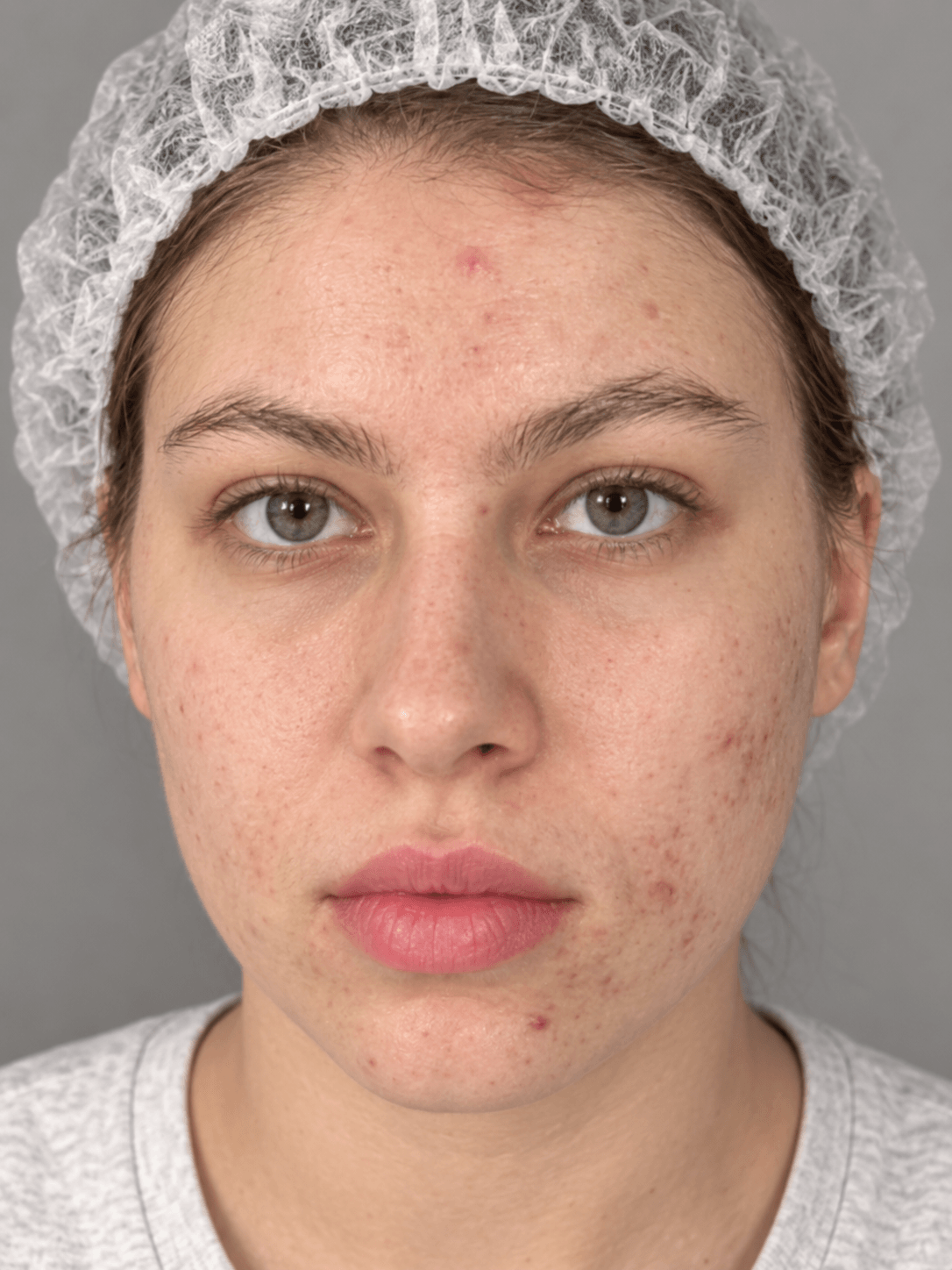 Visage après le protocole, avec une apparence de peau plus uniforme et plus nette.