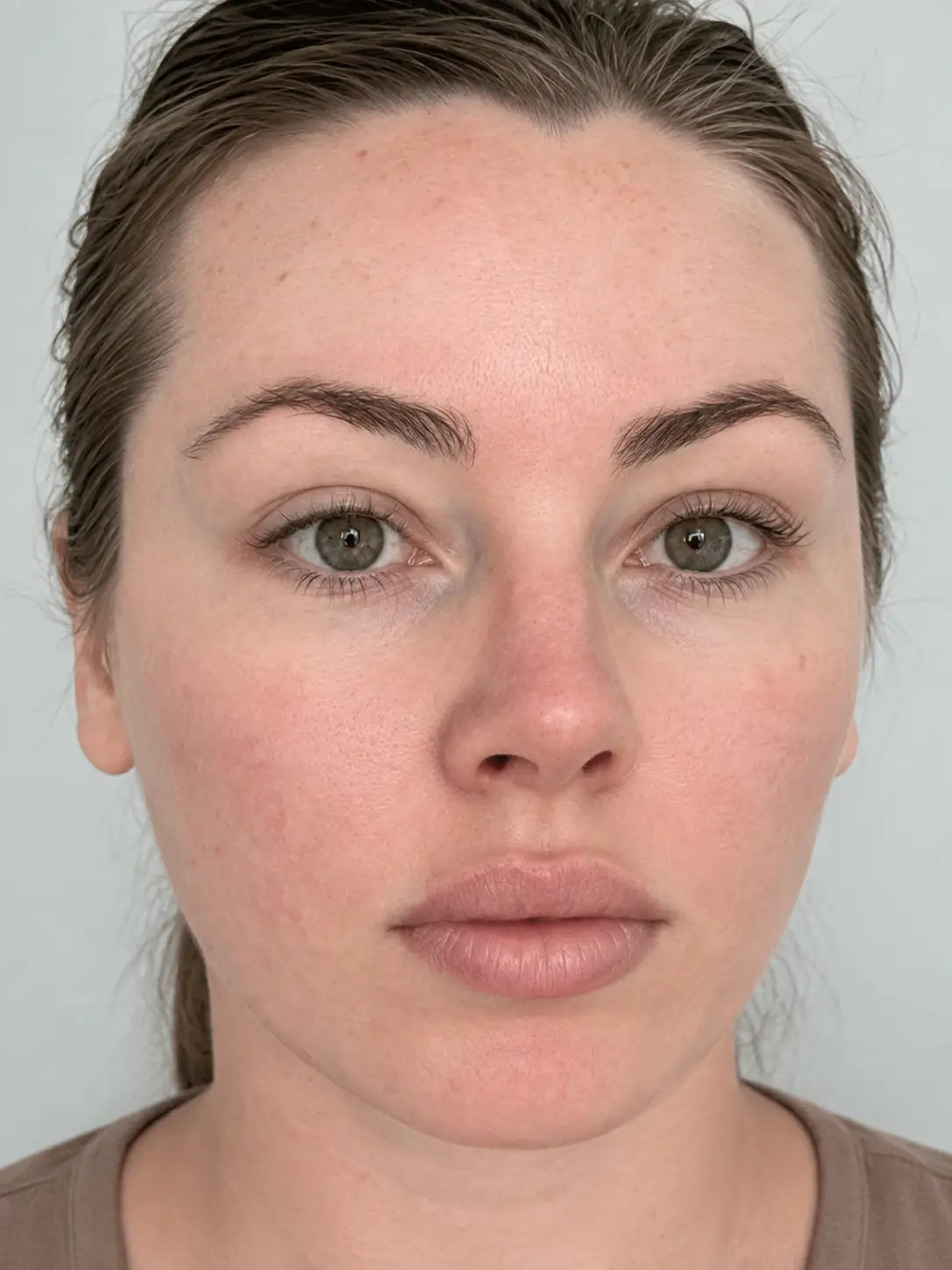 Photo après protocole professionnel, montrant l’évolution visible de l’état de la peau du visage.